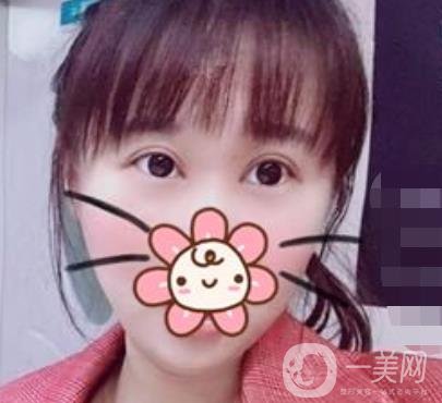 上海華美楊亞益做眼睛多少錢？?jī)r(jià)格表及案例詳情