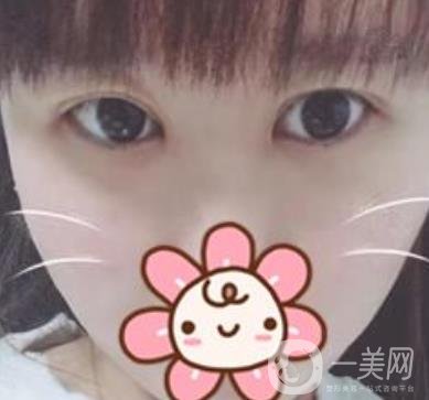 上海華美楊亞益做眼睛多少錢？?jī)r(jià)格表及案例詳情