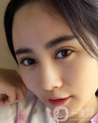 北京處整形外科價(jià)格(目)表2020一覽，附雙眼皮案例