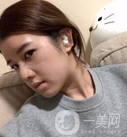 鹽城東方女子整形醫(yī)院價(jià)格表明細(xì)，附隆鼻案例