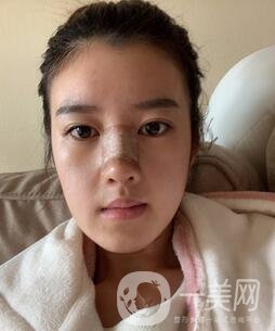 鹽城東方女子整形醫(yī)院價(jià)格表明細(xì)，附隆鼻案例