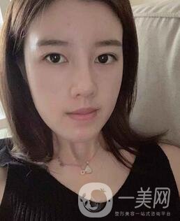 鹽城東方女子整形醫(yī)院價(jià)格表明細(xì)，附隆鼻案例
