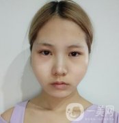運(yùn)城中心醫(yī)院整形外科價(jià)格表，附顴骨降低案例分享