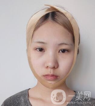 運城中心醫(yī)院整形外科價格表，附顴骨降低案例分享