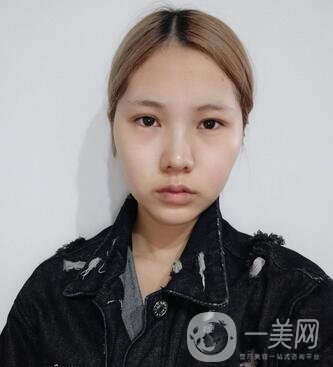 運城中心醫(yī)院整形外科價格表，附顴骨降低案例分享