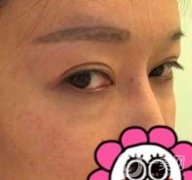 北京友誼醫(yī)院整形科祛眼袋果好不好？2020年價格價目收費曝光啦