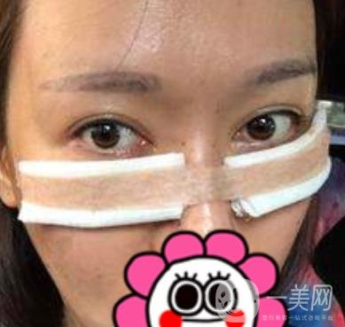北京友誼醫(yī)院整形科祛眼袋*果好不好？2020年價(jià)格價(jià)目收費(fèi)曝光啦