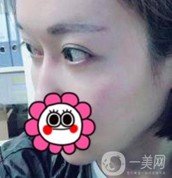 北京友誼醫(yī)院整形科祛眼袋*果好不好？2020年價(jià)格價(jià)目收費(fèi)曝光啦