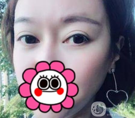 北京友誼醫(yī)院整形科祛眼袋*果好不好？2020年價(jià)格價(jià)目收費(fèi)曝光啦