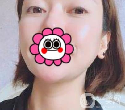 北京友誼醫(yī)院整形科祛眼袋*果好不好？2020年價(jià)格價(jià)目收費(fèi)曝光啦