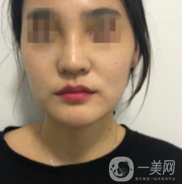 深圳人民醫(yī)院整形外科價(jià)目表，附隆鼻案例