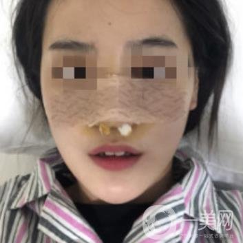 深圳人民醫(yī)院整形外科價(jià)目表，附隆鼻案例