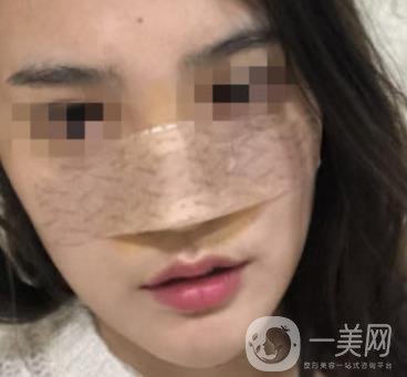 深圳人民醫(yī)院整形外科價(jià)目表，附隆鼻案例