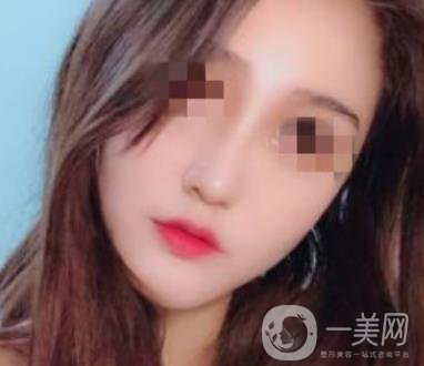 深圳人民醫(yī)院整形外科價(jià)目表，附隆鼻案例
