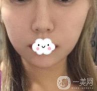 華西口腔醫(yī)院*多少錢？附術(shù)后果前后