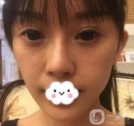 金華中心醫(yī)院整形科價(jià)格表及自體脂肪填充面部案例展示