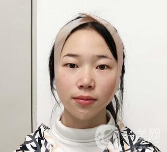 西安高一生醫(yī)療美容醫(yī)院價(jià)格表，附面部吸脂案例分享
