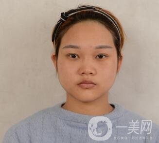 成都銅雀臺整形醫(yī)院隆鼻案例分享，附全新價格表