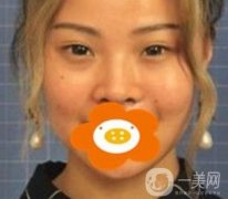 蚌埠美萊塢整形醫(yī)院玻尿酸隆鼻果如何？價(jià)格表2020年收費(fèi)公布