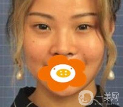 蚌埠美萊塢整形醫(yī)院玻尿酸隆鼻*果如何？?jī)r(jià)格表2020年收費(fèi)公布