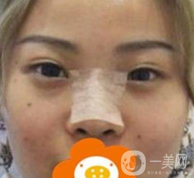 蚌埠美萊塢整形醫(yī)院玻尿酸隆鼻*果如何？?jī)r(jià)格表2020年收費(fèi)公布