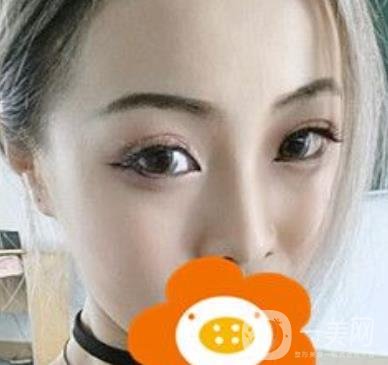 蚌埠美萊塢整形醫(yī)院玻尿酸隆鼻*果如何？?jī)r(jià)格表2020年收費(fèi)公布