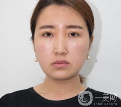 常州美貝爾整形美容醫(yī)院*注射多少錢？價格明細(xì)和*果圖展示