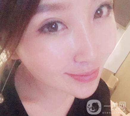 常州美貝爾整形美容醫(yī)院*注射多少錢？價格明細(xì)和*果圖展示