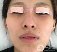 大連市中心醫(yī)院雙眼皮怎么樣？費(fèi)用是多少？真人恢復(fù)經(jīng)歷自述