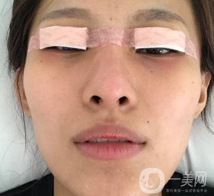 大連市中心醫(yī)院雙眼皮怎么樣？費(fèi)用是多少？真人恢復(fù)經(jīng)歷自述
