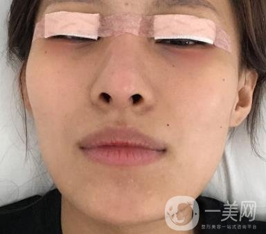 大連市中心醫(yī)院雙眼皮怎么樣？費(fèi)用是多少？真人恢復(fù)經(jīng)歷自述