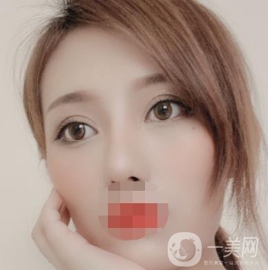 大連市中心醫(yī)院雙眼皮怎么樣？費(fèi)用是多少？真人恢復(fù)經(jīng)歷自述