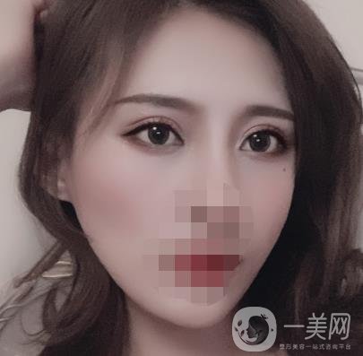 大連市中心醫(yī)院雙眼皮怎么樣？費(fèi)用是多少？真人恢復(fù)經(jīng)歷自述