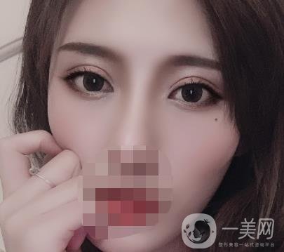 大連市中心醫(yī)院雙眼皮怎么樣？費(fèi)用是多少？真人恢復(fù)經(jīng)歷自述