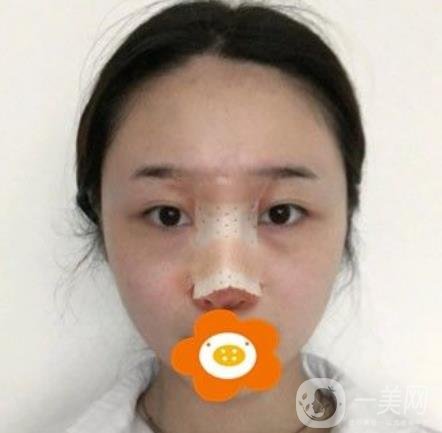 南京美貝爾整形醫(yī)院做*好不好？?jī)r(jià)格表費(fèi)用明細(xì)和*果圖參考