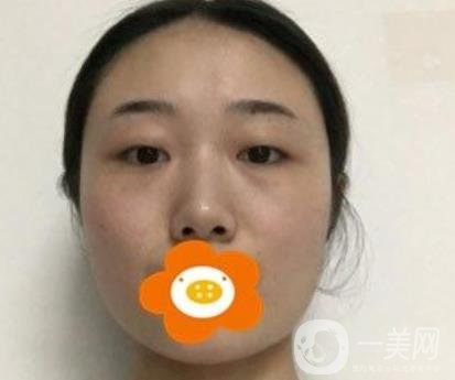南京美貝爾整形醫(yī)院做*好不好？?jī)r(jià)格表費(fèi)用明細(xì)和*果圖參考