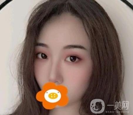 南京美貝爾整形醫(yī)院做*好不好？?jī)r(jià)格表費(fèi)用明細(xì)和*果圖參考