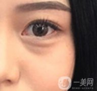 廣東省人民醫(yī)院整形科去眼袋怎么樣？?jī)?nèi)含案例及價(jià)格一覽表
