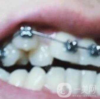 貴州口腔醫(yī)院正畸醫(yī)生信息介紹?內(nèi)含牙齒美容項(xiàng)目價(jià)格表及案例