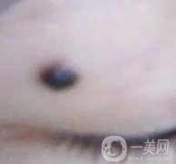 青醫(yī)附院王彥進(jìn)去痣怎么樣？價格表及果展示