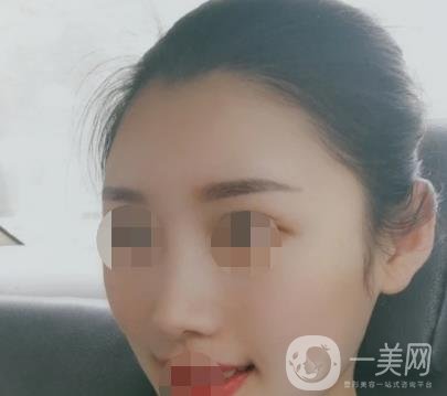 青醫(yī)附院王彥進(jìn)去痣怎么樣？?jī)r(jià)格表及*果展示