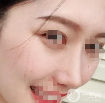 青醫(yī)附院王彥進(jìn)去痣怎么樣？?jī)r(jià)格表及*果展示