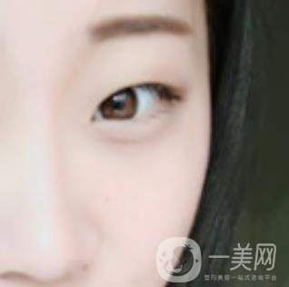 沈陽百嘉麗醫(yī)院價格表2020，附雙眼皮案例分享