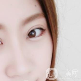 沈陽百嘉麗醫(yī)院價格表2020，附雙眼皮案例分享