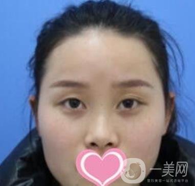 沈陽名流整形醫(yī)院價格表，附雙眼皮+隆鼻案例