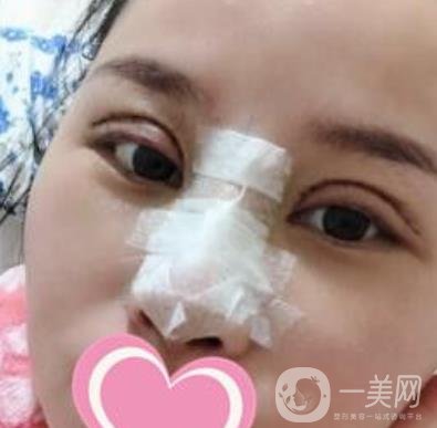 沈陽名流整形醫(yī)院價格表，附雙眼皮+隆鼻案例