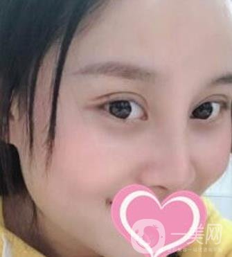 沈陽名流整形醫(yī)院價格表，附雙眼皮+隆鼻案例