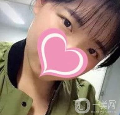 濟南中心醫(yī)院價格表，雙眼皮整形日記公布