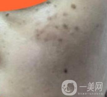 沈陽伊美爾整形醫(yī)院價格表，附祛斑*果展示