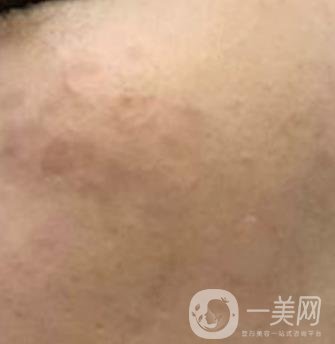 沈陽伊美爾整形醫(yī)院價格表，附祛斑*果展示